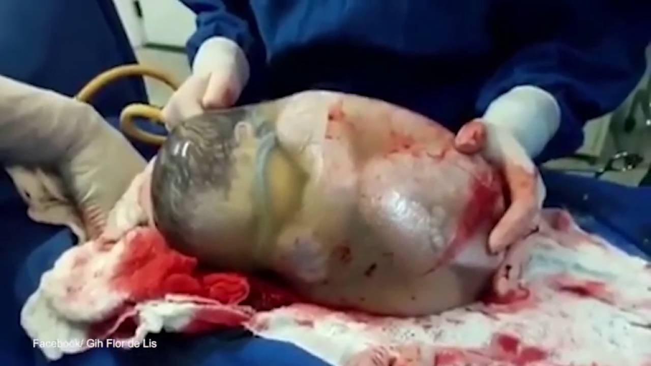 Här fångas ett sällsynt ögonblick när barnet föds i en helt intakt fostersäck